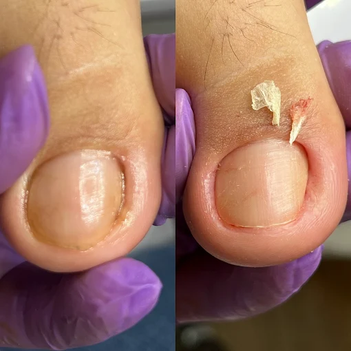 Antes e depois do tratamento de unha encravada